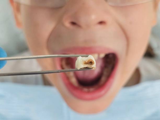 Best Emergency Dental Extractions in Dimondale, MI